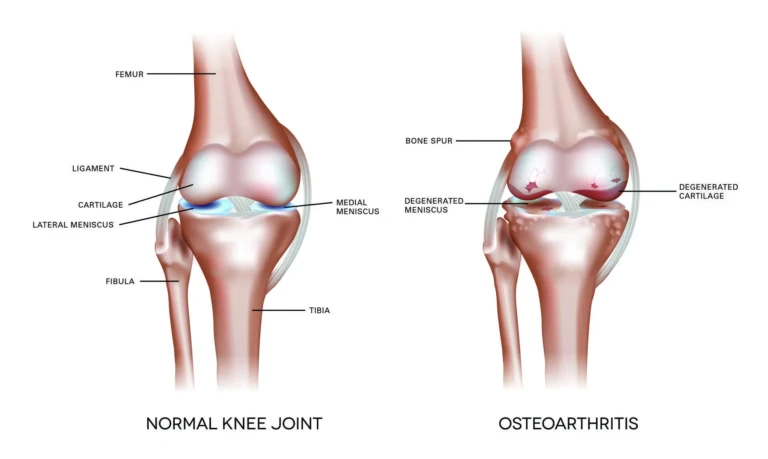 Labelled illustration comparing a normal knee joint with an osteoarthritic knee showing degenerated cartilage and bone spurs