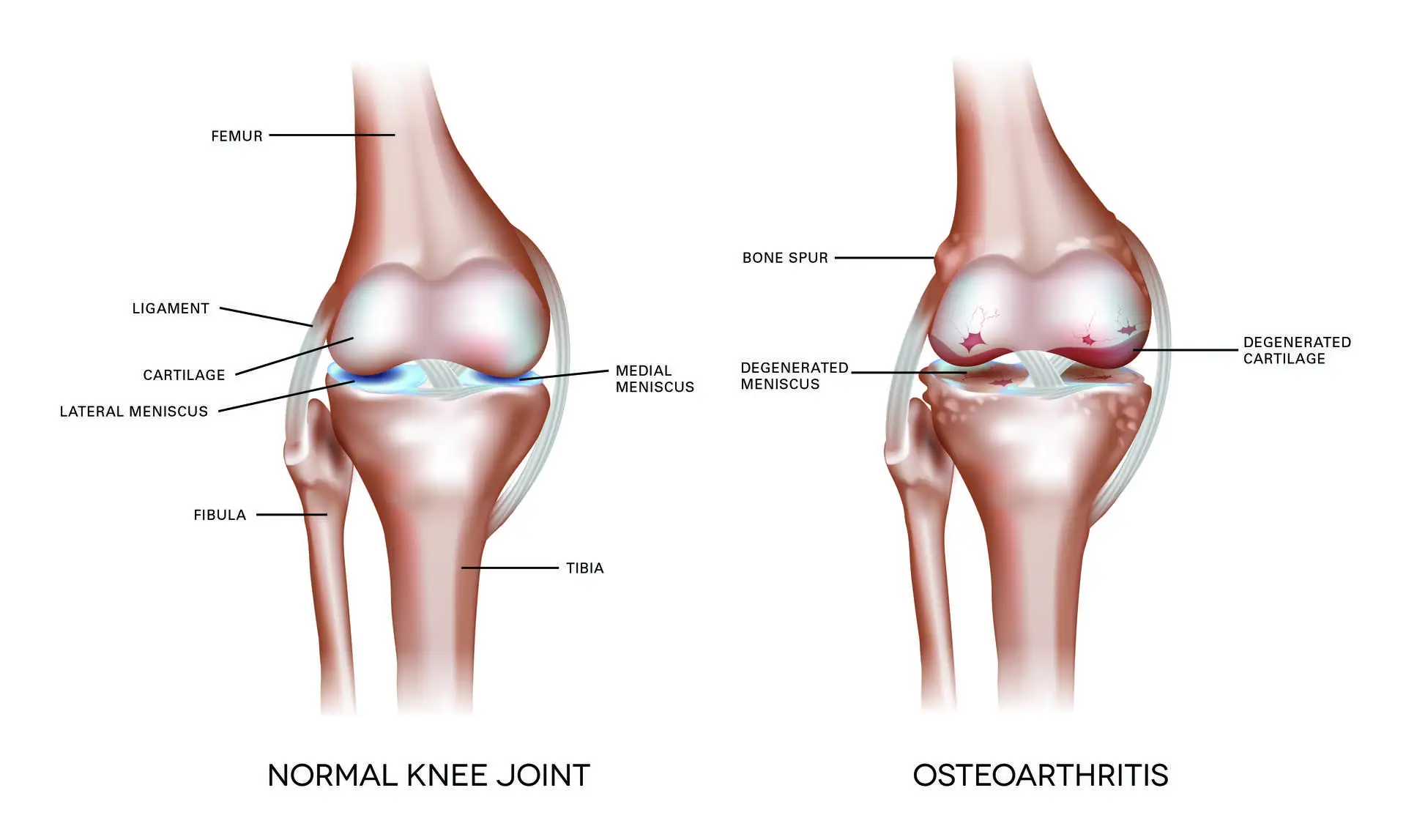Labelled illustration comparing a normal knee joint with an osteoarthritic knee showing degenerated cartilage and bone spurs